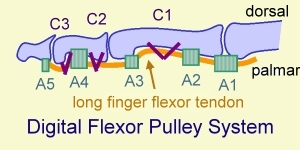 Figure 5 for case Ulnar aspect A3 pulley tear with bowstringing of the flexor tendons